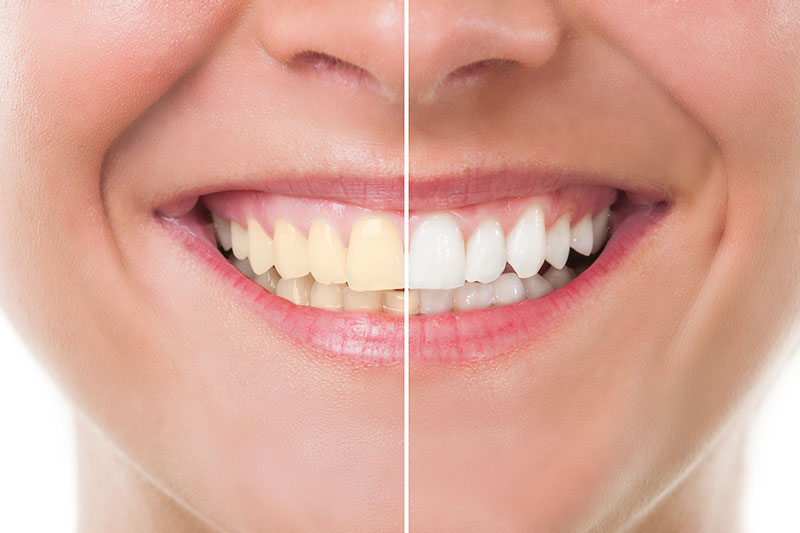Teeth Whitening in Vallejo